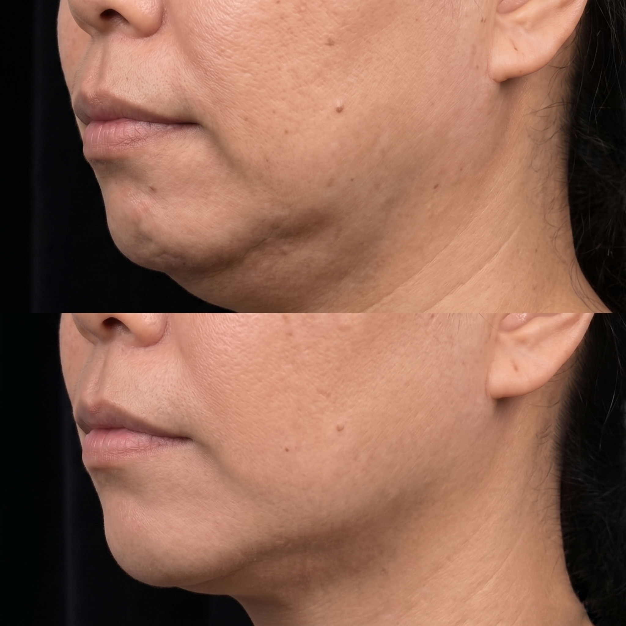 Thermage FLX client before and after result